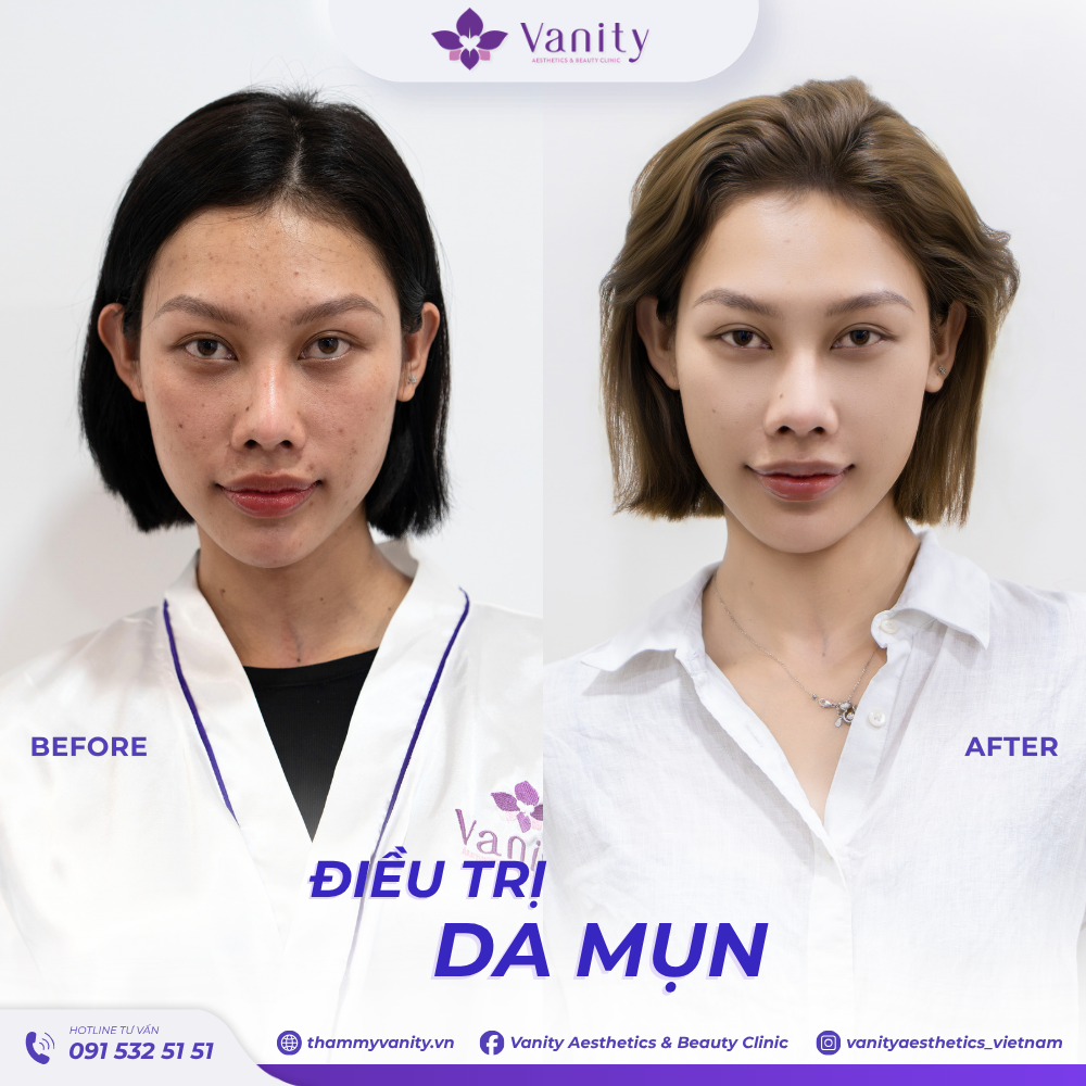 ĐIỀU TRỊ DA MỤN